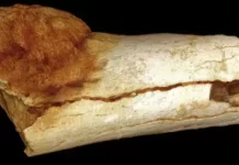 Почти 2 млн лет назад. Ученые обнаружили, когда впервые появился рак у человека